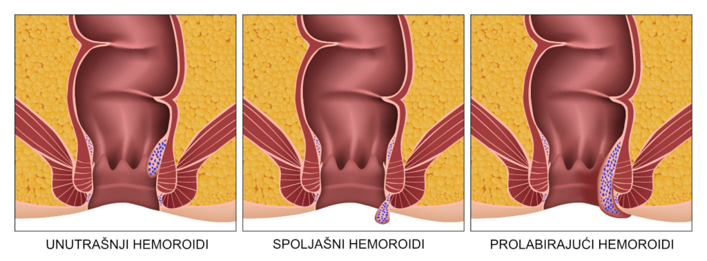 Vrste hemoroida