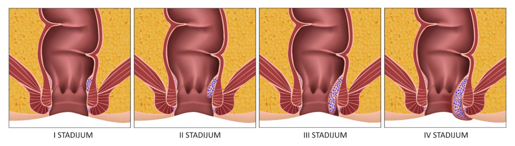 Stadijumi hemoroida