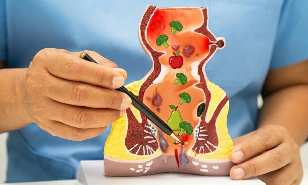 Ishrana kod hemoroida